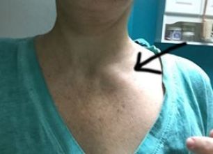 lymph-nodes-neck-2