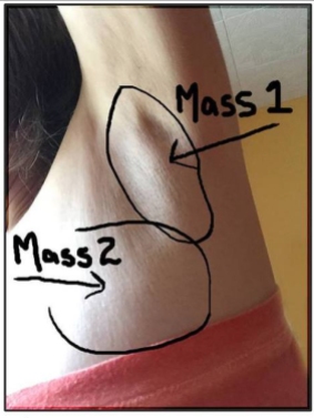 lymph-nodes-masses-2 cropped